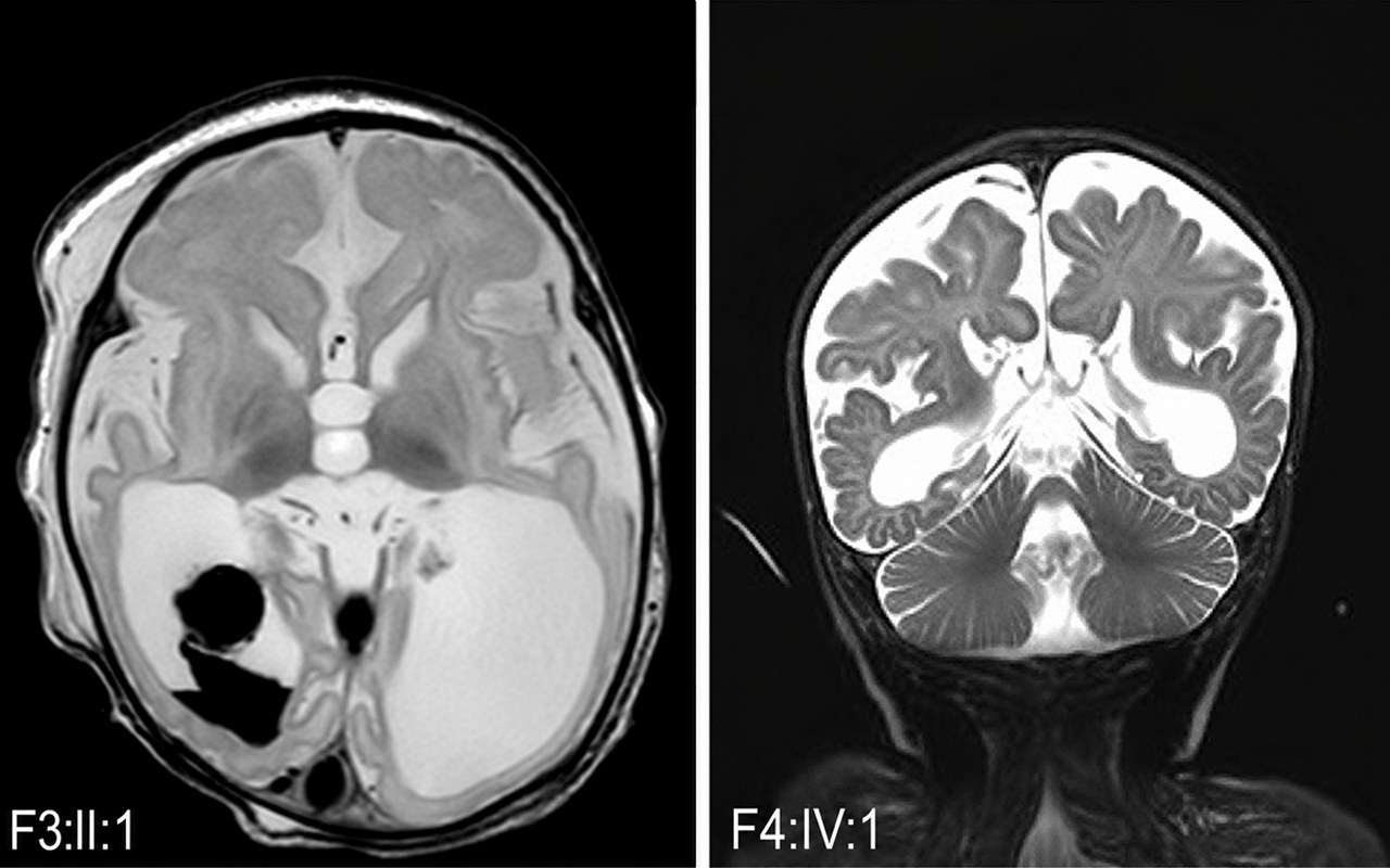 Science solves genetic mystery behind fatal brain disorder in babies and children